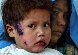 Σοκαριστικό: Το ISIS έχει εξαπλώσει ιό που τρώει το δέρμα των ανθρώπων! Δείτε τις φρικιαστικές εικόνες... [photos] - Φωτογραφία 1