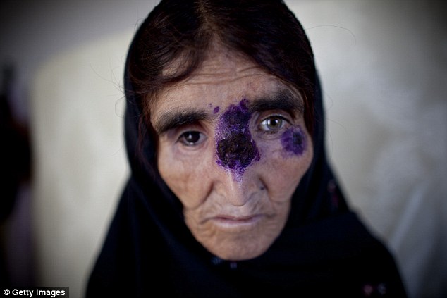 Σοκαριστικό: Το ISIS έχει εξαπλώσει ιό που τρώει το δέρμα των ανθρώπων! Δείτε τις φρικιαστικές εικόνες... [photos] - Φωτογραφία 3