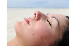 Το αλφάβητο (ABCD) για να προφυλαχτούμε από το μελάνωμα