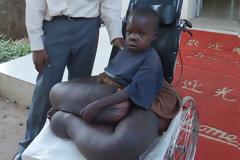 VIDEO | Ανήλικος πάσχει από ελεφαντίαση