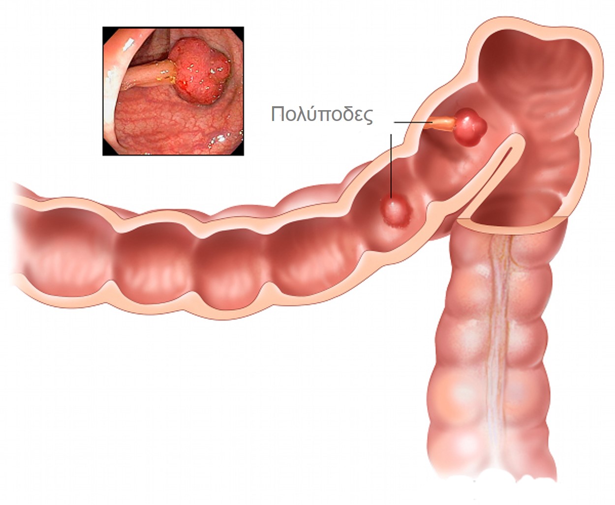 Πολύποδες παχέος εντέρου: Όλα όσα πρέπει να ξέρετε [photos] - Φωτογραφία 2