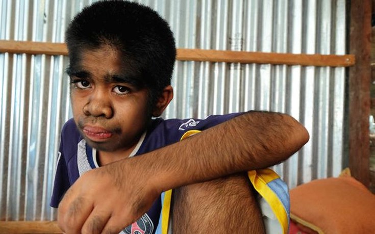 ΣΟΚΑΡΙΣΤΙΚΟ: Ο 13χρονος λυκάνθρωπος που λατρεύεται σαν Θεός - Αρνείται οποιαδήποτε θεραπεία γιατί θεωρεί τον εαυτό του... [photos] - Φωτογραφία 2