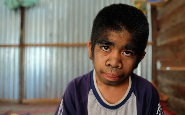 ΣΟΚΑΡΙΣΤΙΚΟ: Ο 13χρονος λυκάνθρωπος που λατρεύεται σαν Θεός - Αρνείται οποιαδήποτε θεραπεία γιατί θεωρεί τον εαυτό του... [photos] - Φωτογραφία 3