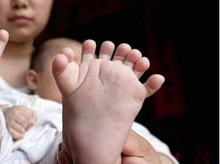 ΑΠΙΣΤΕΥΤΟ: Μωρό στην Κίνα γεννήθηκε με 31 δάχτυλα σε χέρια και πόδια [photos] - Φωτογραφία 1