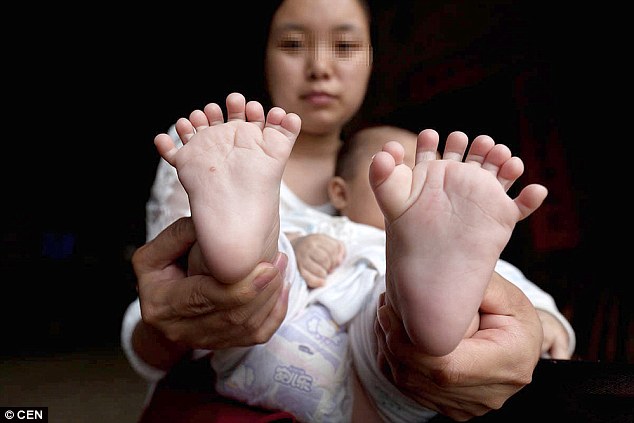 ΑΠΙΣΤΕΥΤΟ: Μωρό στην Κίνα γεννήθηκε με 31 δάχτυλα σε χέρια και πόδια [photos] - Φωτογραφία 3