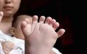 ΑΠΙΣΤΕΥΤΟ: Μωρό στην Κίνα γεννήθηκε με 31 δάχτυλα σε χέρια και πόδια [photos]