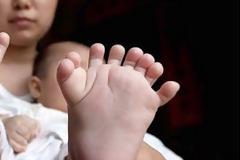 ΑΠΙΣΤΕΥΤΟ: Μωρό στην Κίνα γεννήθηκε με 31 δάχτυλα σε χέρια και πόδια [photos]
