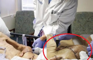 Έραψαν το χέρι 87χρονου στο στομάχι του. Μόλις δείτε το λόγο, θα σας πέσει το σαγόνι.. [ΣΟΚΑΡΙΣΤΙΚΕΣ ΕΙΚΟΝΕΣ] - Φωτογραφία 1