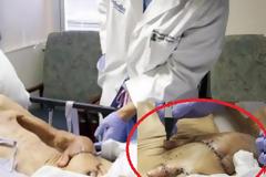Έραψαν το χέρι 87χρονου στο στομάχι του. Μόλις δείτε το λόγο, θα σας πέσει το σαγόνι.. [ΣΟΚΑΡΙΣΤΙΚΕΣ ΕΙΚΟΝΕΣ]