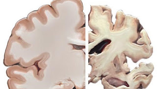 Οι εγκεφαλικές πλάκες που οδηγούν στο Αλτσχάιμερ μπορεί να δημιουργούνται από άμυνα - Φωτογραφία 1