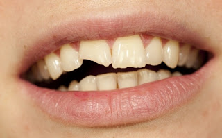 Τραυματισμοί των δοντιών: Ποιες είναι οι πρώτες βοήθειες; - Φωτογραφία 1