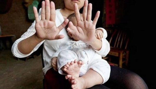 Μωρό γεννήθηκε με 31 δάχτυλα [photos] - Φωτογραφία 2