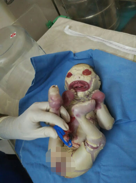 ΣΟΚ: Γεννήθηκε μωρό χωρίς... δέρμα [photos] - Φωτογραφία 2