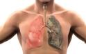 Ο καλύτερος φυσικός τρόπος να καθαρίσετε τους πνεύμονες σας από πίσσα και νικοτίνη