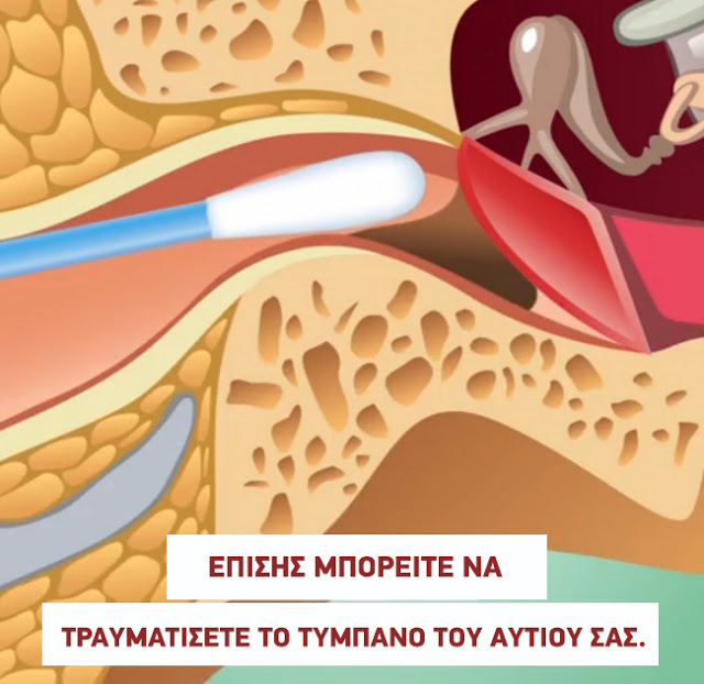 Γιατί δεν πρέπει να χρησιμοποιείτε μπατονέτες στα αυτιά σας; - Φωτογραφία 4