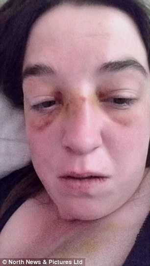 Σοκάρουν οι φωτογραφίες της 27χρονης που έζησε τον χειρότερο εφιάλτη της στα χέρια του αρραβωνιαστικού της - Φωτογραφία 3
