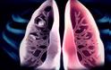 Φυματίωση: Η ύπουλη ασθένεια που μπορεί να οδηγήσει στο θάνατο - Ποια είναι τα συμπτώματα;