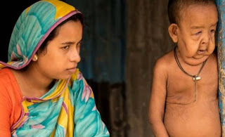 Μπανγκλαντές: Ο πραγματικός «Μπέντζαμιν Μπάτον» - Ο 4χρονος που πάσχει από προγηρία... [photo+video] - Φωτογραφία 1