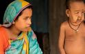 Μπανγκλαντές: Ο πραγματικός «Μπέντζαμιν Μπάτον» - Ο 4χρονος που πάσχει από προγηρία... [photo+video]