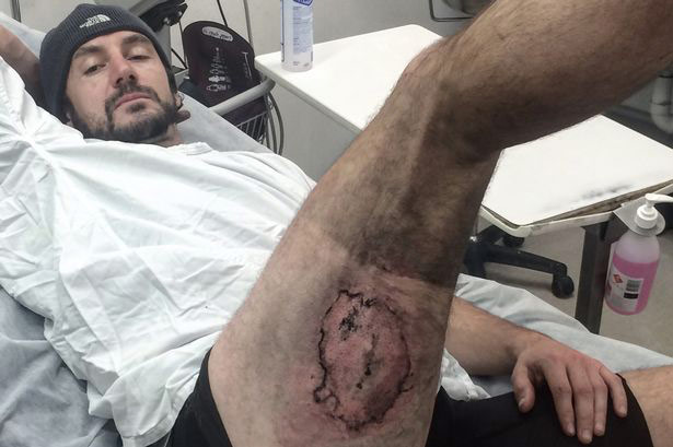 Ποδηλάτης στην Αυστραλία έπαθε εγκαύματα από το iPhone του - Φωτογραφία 3