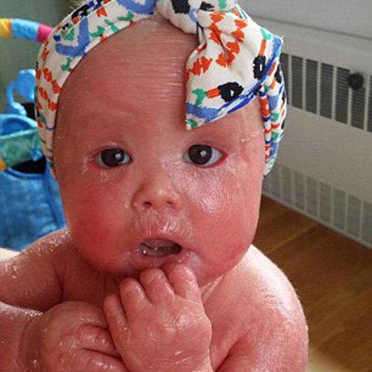 Σοκ! Αυτό το μωρό αλλάζει δέρμα κάθε τέσσερις ώρες - Η ζωή του βρίσκεται σε κίνδυνο - Φωτογραφία 3