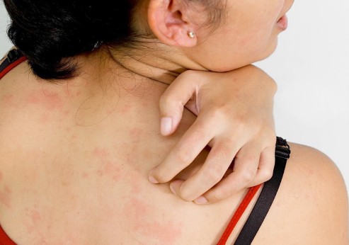 Αλλεργίες και αναφυλαξία το καλοκαίρι - Φωτογραφία 1