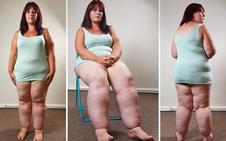 Η 29χρονη με τα πόδια που ζυγίζουν... 50 κιλά! - Φωτογραφία 1