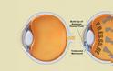 Γλαύκωμα: ανάκτηση της χαμένης όρασης υπόσχεται νέα μέθοδος θεραπείας - Φωτογραφία 2