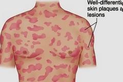Σπογγοειδής μυκητίαση (mycosis fungoides) - Δερματικό λέμφωμα Τ-κυττάρων...