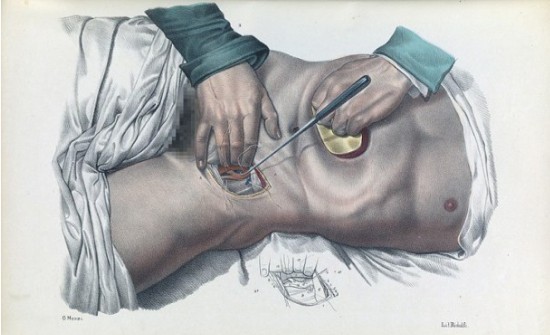 Πώς γίνονταν οι χειρουργικές επεμβάσεις το 1840 - ΣΥΓΚΛΟΝΙΣΤΙΚΕΣ εικόνες από χειρουργεία ΧΩΡΙΣ ΑΝΑΙΣΘΗΤΙΚΟ... [photos] - Φωτογραφία 10