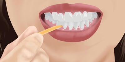 Είναι καλό να καθαρίζουμε τα δόντια μας με οδοντογλυφίδες; - Φωτογραφία 5