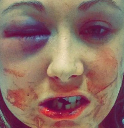 ΕΞΟΡΓΙΣΤΙΚΕΣ εικόνες: Της έσπασε το σαγόνι και τρία δόντια επειδή δεν ήθελε να κάνουν... [photos] - Φωτογραφία 5