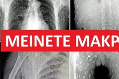 ΠΡΟΣΟΧΗ: Όταν είδε τις Ακτινογραφίες ΣΟΚΑΡΙΣΤΗΚΕ - Σκουλήκια του Ετρωγαν τα Σωθικά και ο Λόγος κάτι που Πολλοί από εμάς Τρώμε... [photos]