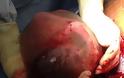 Συγκλονιστικό βίντεο: Μωρό γεννήθηκε στον αμνιακό του σάκο! [photos] - Φωτογραφία 2