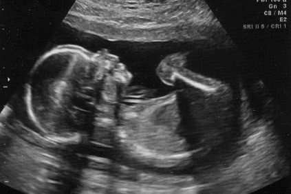Το έμβρυο είχε κάτι το ΑΦΥΣΙΚΟ! Η φωτογραφία του υπέρηχου που ΣΟΚΑΡΕ - Φωτογραφία 1