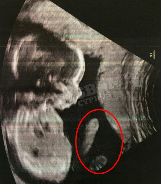 Το έμβρυο είχε κάτι το ΑΦΥΣΙΚΟ! Η φωτογραφία του υπέρηχου που ΣΟΚΑΡΕ - Φωτογραφία 2