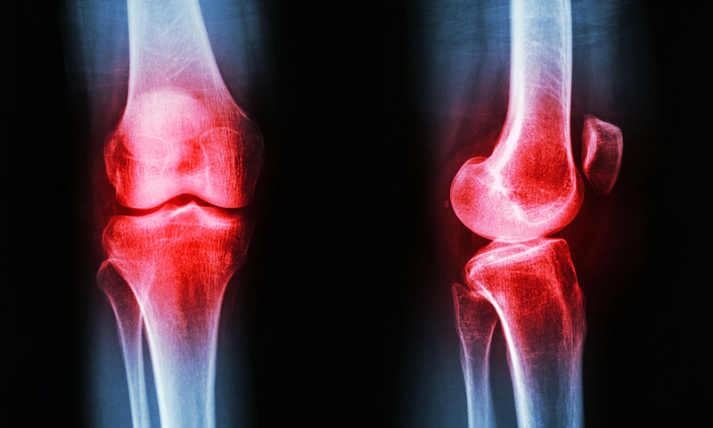 Οστεοαρθρίτιδα γόνατος: Οι παράγοντες κινδύνου & πώς θα μειώσετε τη φθορά - Φωτογραφία 1