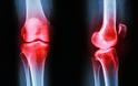 Οστεοαρθρίτιδα γόνατος: Οι παράγοντες κινδύνου & πώς θα μειώσετε τη φθορά