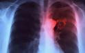 Επανεμφάνιση της φυματίωσης στην Ελλάδα λόγω πτώσης του βιωτικού επιπέδου