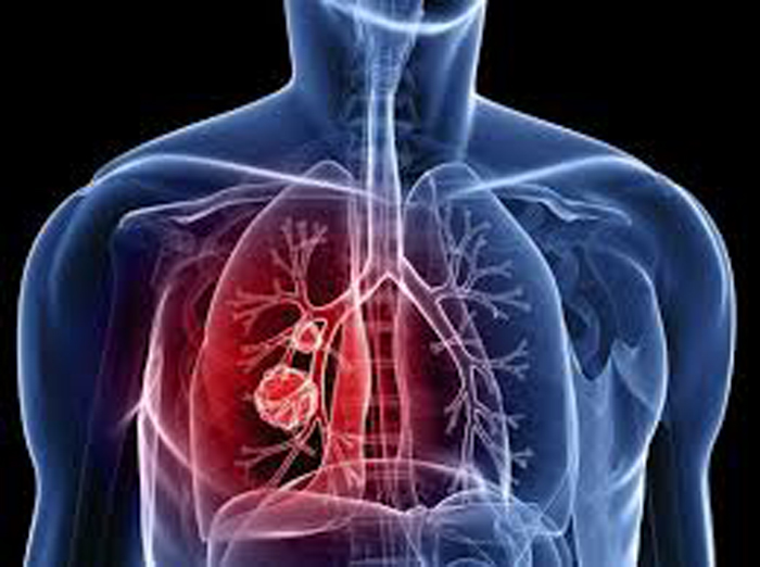 Έγκριση του Αtezolizumab απο τον FDA για την αντιμετώπιση του καρκίνου του πνεύμονα - Φωτογραφία 1