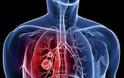 Έγκριση του Αtezolizumab απο τον FDA για την αντιμετώπιση του καρκίνου του πνεύμονα