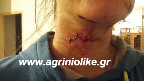 Αγρίνιο: Απίστευτο,γυναίκα παρολίγον να χάσει την ζωή της από επίθεση γερακιού - Εικόνες ΣΟΚ - Φωτογραφία 2