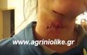 Αγρίνιο: Απίστευτο,γυναίκα παρολίγον να χάσει την ζωή της από επίθεση γερακιού - Εικόνες ΣΟΚ - Φωτογραφία 2