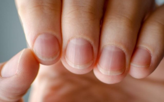 Πέντε συμπτώματα στα νύχια που δείχνουν ύπουλα προβλήματα υγείας - Φωτογραφία 1