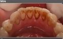 Πείτε ΑΝΤΙΟ στην κακή αναπνοή και την πλάκα και σκοτώστε τα βλαβερά βακτήρια στο στόμα σας μόνο με ένα συστατικό! - Φωτογραφία 2