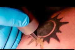 Μετανιώσατε για κάποιο τατουάζ; Δείτε πώς γίνεται αφαίρεση με λέιζερ [video]