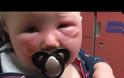 Αντηλιακό για παιδιά προκάλεσε αυτό σε μωρό 1 έτους - Τι να προσέχετε πάντα [photos+video]