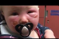 Αντηλιακό για παιδιά προκάλεσε αυτό σε μωρό 1 έτους - Τι να προσέχετε πάντα [photos+video]