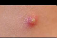 Πώς και γιατί δημιουργούνται τα σπυράκια; [vid]