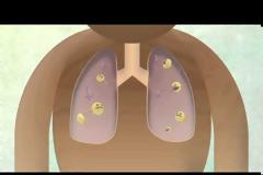 Τι είναι η φυματίωση; Συμπτώματα, θεραπεία, εμβόλιο. Τι γίνεται με τους πρόσφυγες;